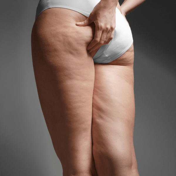 La cellulite, qu’est-ce que c’est ?